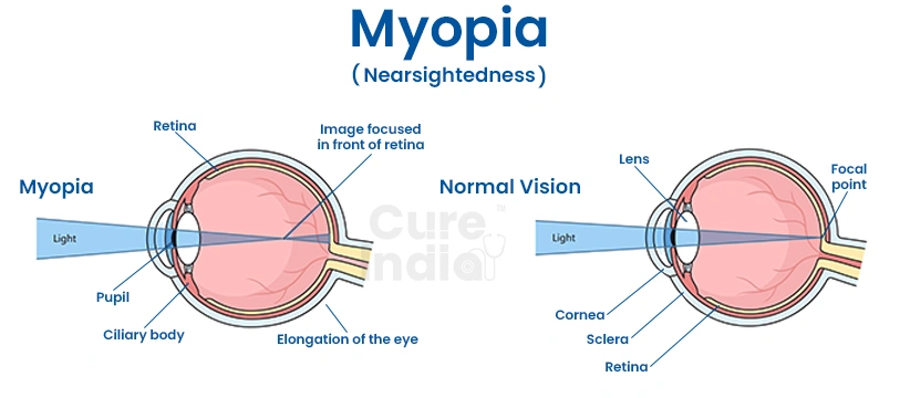how common is high myopia worldwide